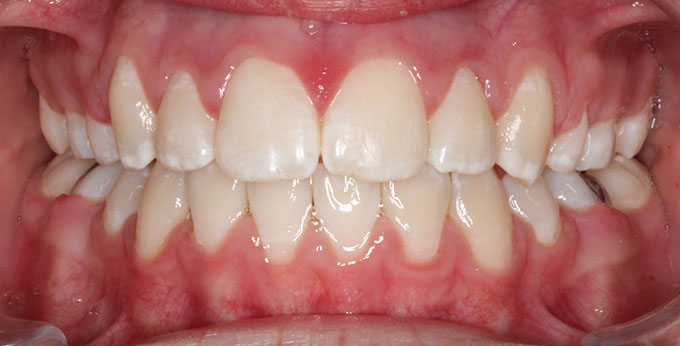 Adult teeth after treatment which consisted of removal of four premolar teeth and adults braces